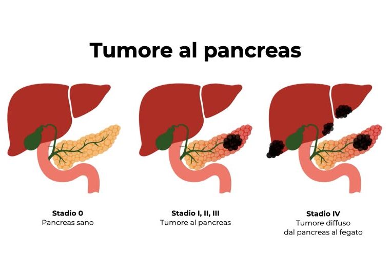 Tumore al pancreas: importante scoperta di scienziati a Milano