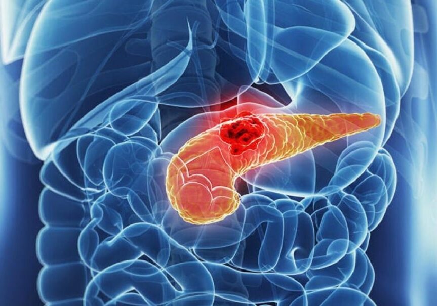 Nuovo risultato della ricerca nella cura del tumore al pancreas