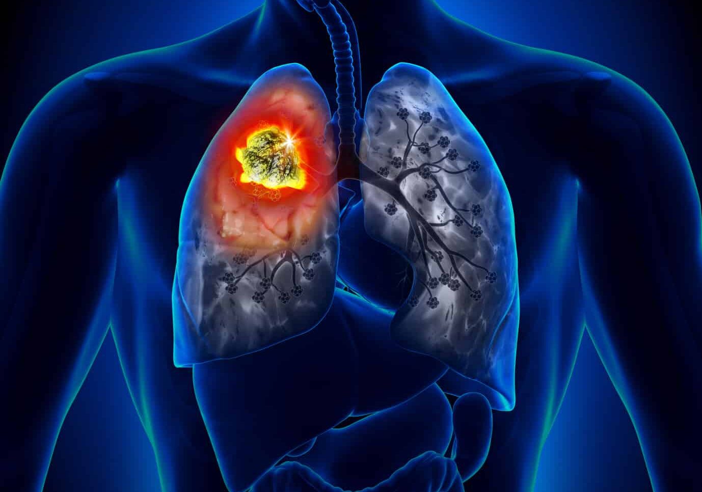 Vaccino contro cancro ai polmoni, via alla sperimentazione