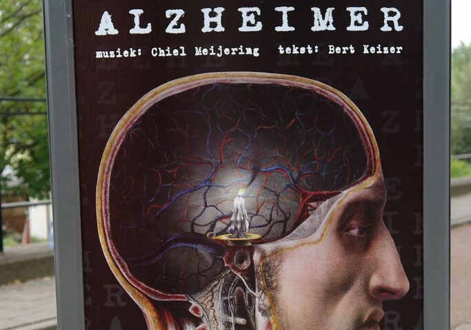 Alzheimer, 55 milioni di casi nel mondo