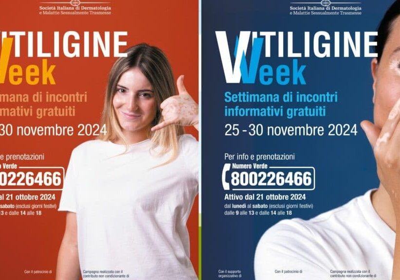 Salute. La ‘Vitiligine Week’ arriva in Lombardia: incontri gratuiti con i dermatologi