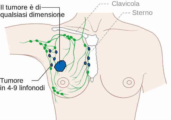 Cancro alla mammella, donne sopravvissute crescono del 20%