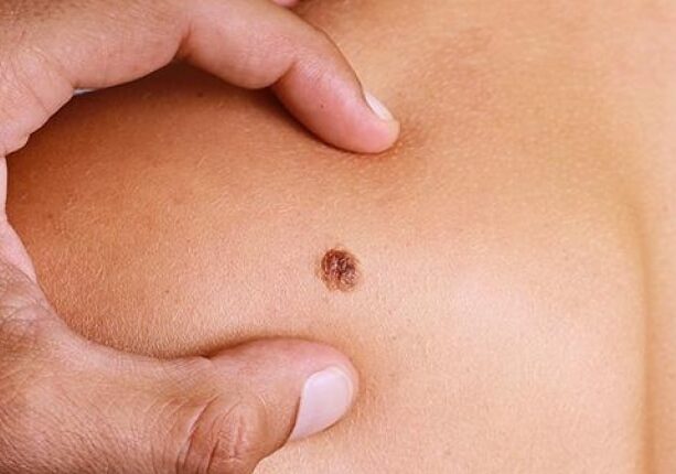 Busto Garolfo e prevenzione: una giornata dedicata alla mappatura dei nevi