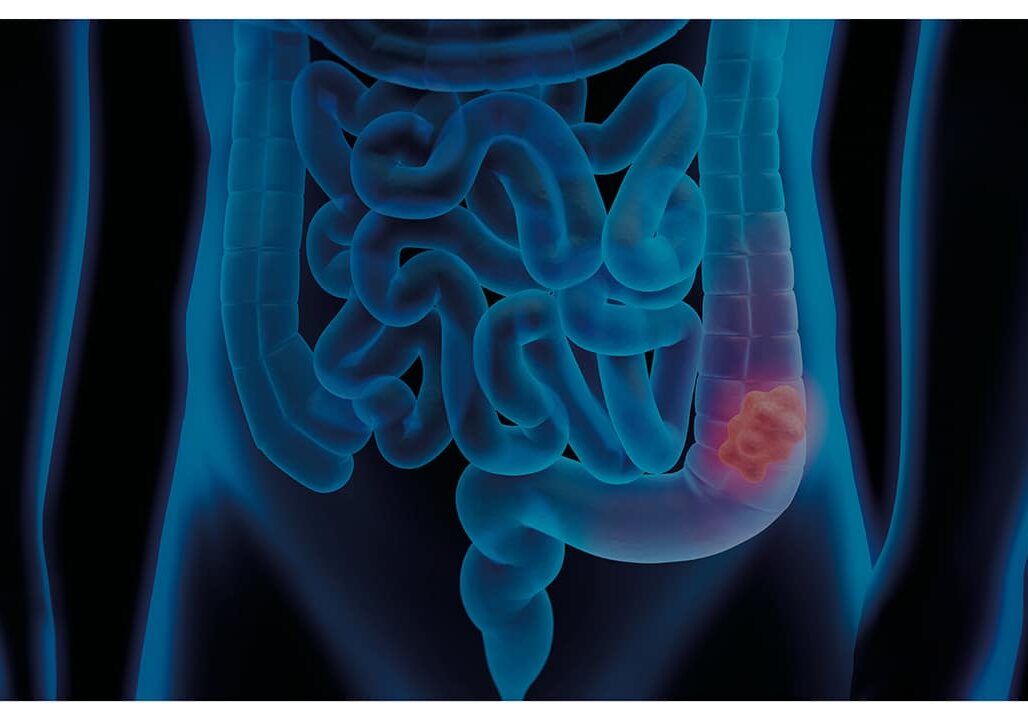 Salute. Tumore del colon-retto, svolta dall’immunoterapia: fino al 30% di remissioni complete