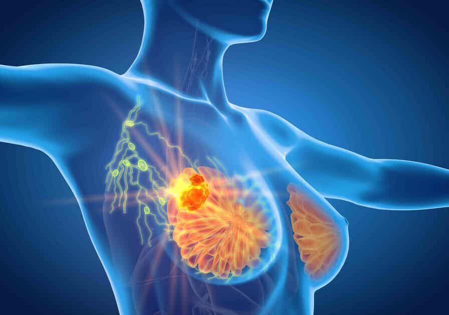 Sanità, tumore al seno: controlli automatici e gratuiti per le donne che hanno concluso le cure